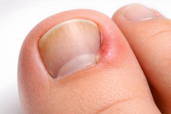 Ongle incarné 
