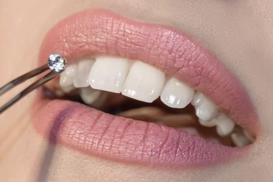Strass dentaire 