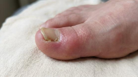 Ongle incarné 