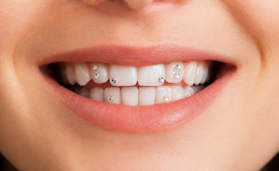 Pose de bijou dents 