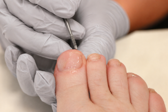 Reconstruction ongles 